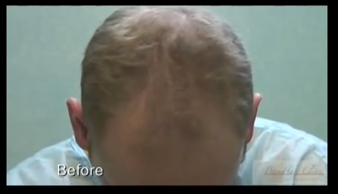 Before Patient's FUE Transplant With 3500 Grafts