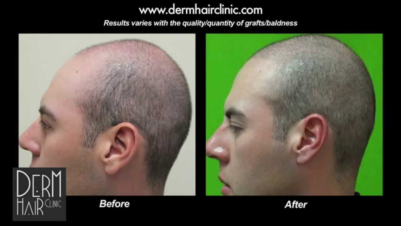 Conservative FUE Hair Transplant using 2000 grafts Gives Density for