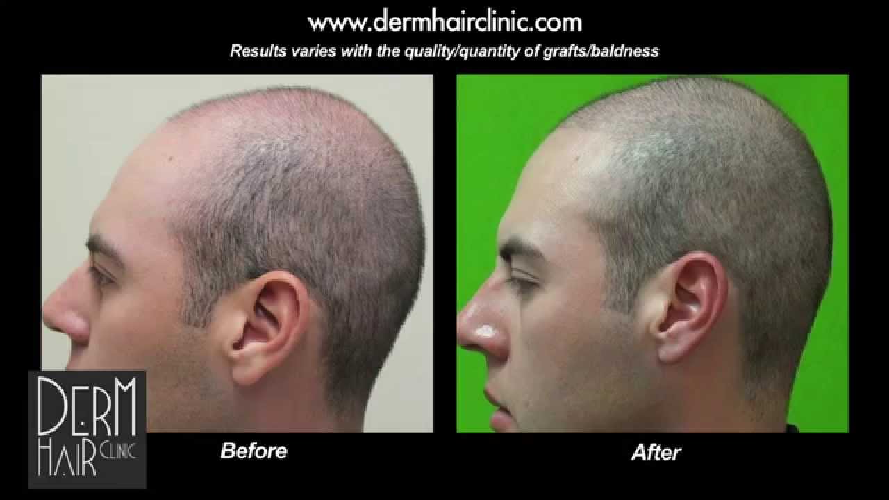 Conservative FUE Hair Transplant Using 2000 Grafts Gives Density