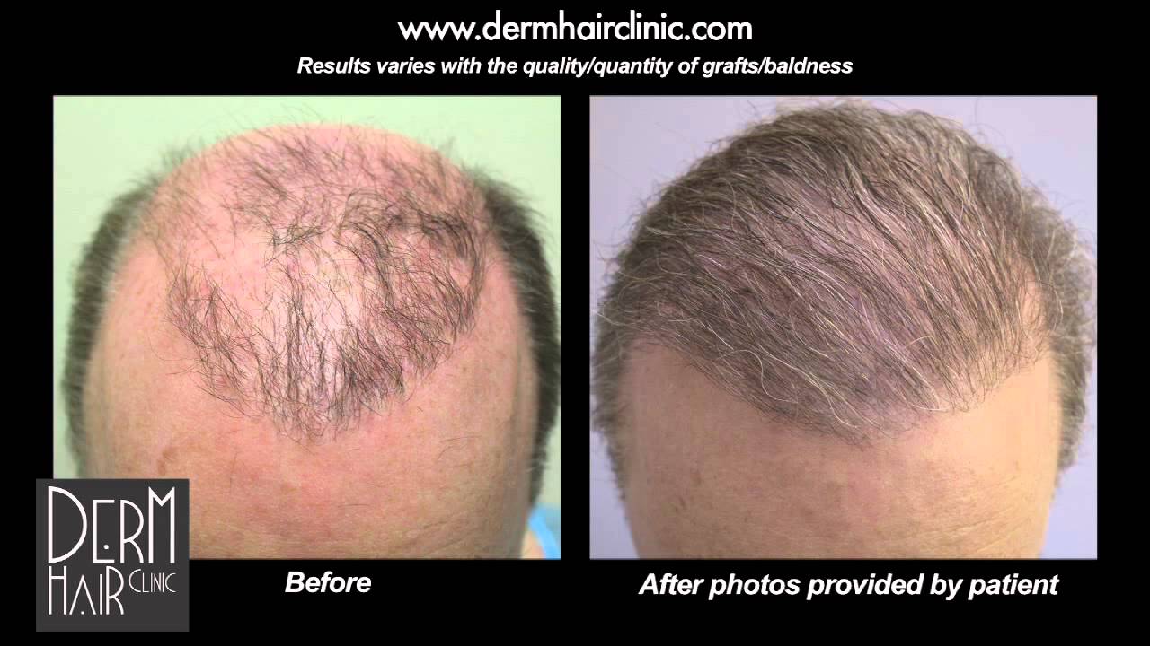 Beard Hair to head Transplant using 5000 grafts for FUE Repair