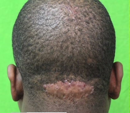 Acne Keloidalis Nuchae Patient Before Surgery