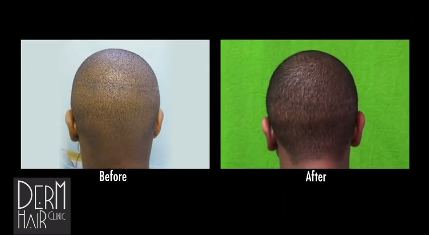 African American Patient- Strip Scar Repair With FUE