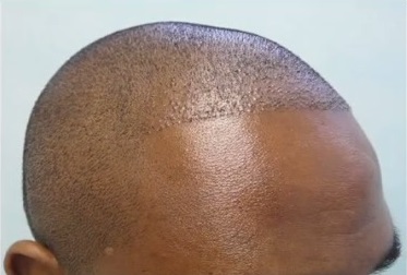 African American Patient Before His FUE Surgery