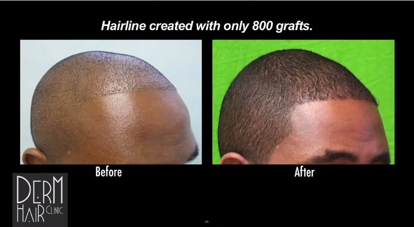 Natural and Youthful Looking Temple Hair Restoration