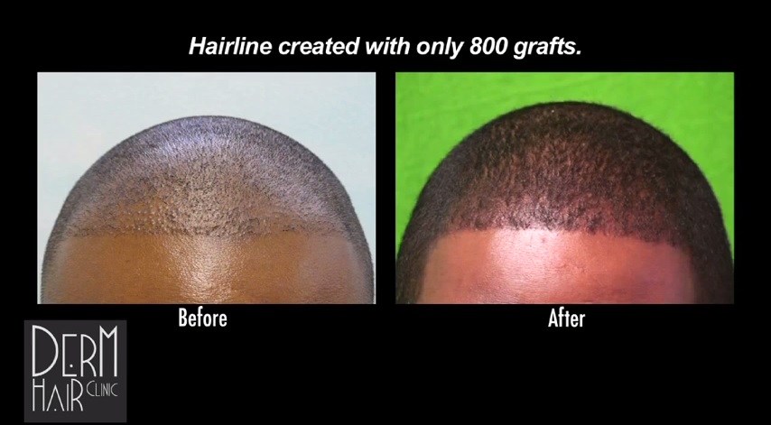 New Hairline Created For African American Patient With FUE
