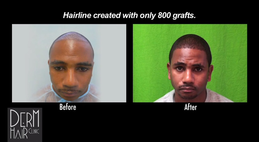 Front View- African American Hair Transplant Results