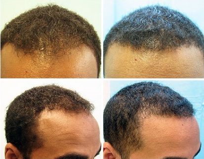 Black Men FUE Hair Transplant Using 1200 grafts by UGraft before and after photos