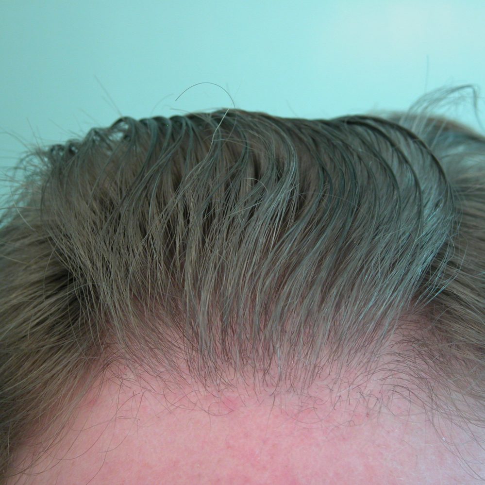 UGraft FUE Hair Transplant pictures