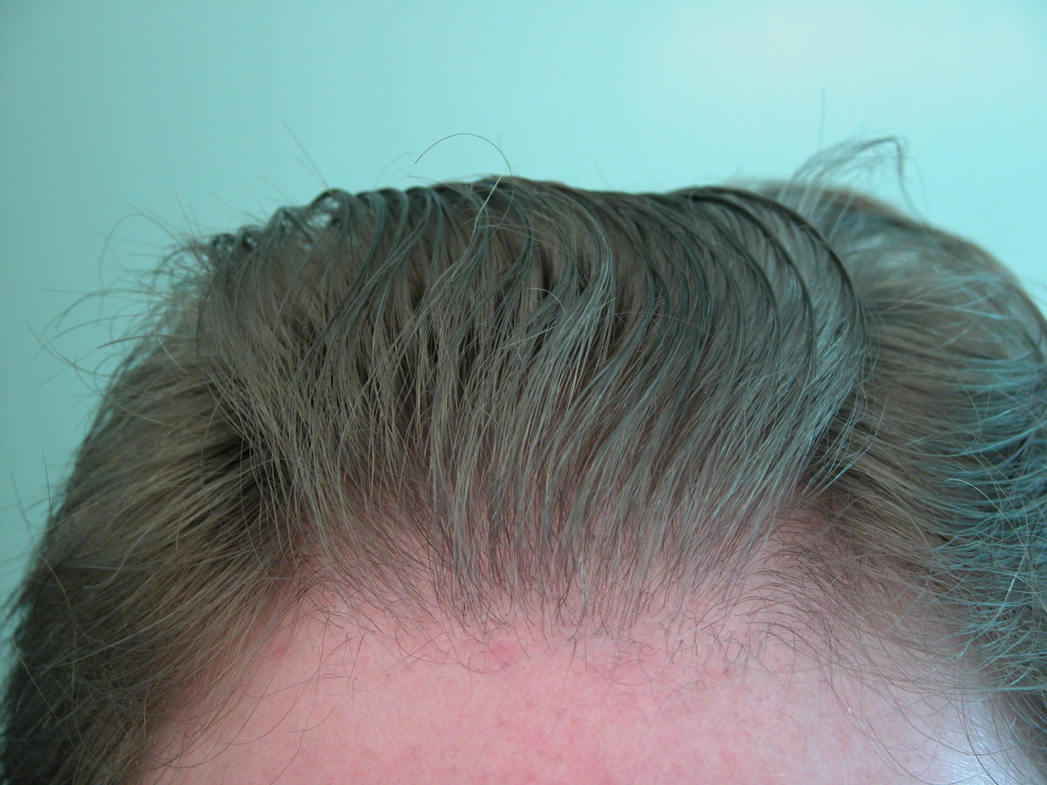 UGraft FUE Hair Transplant pictures