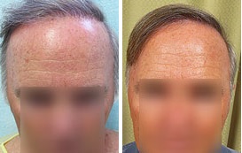 Info on Hair Transplant Surgery