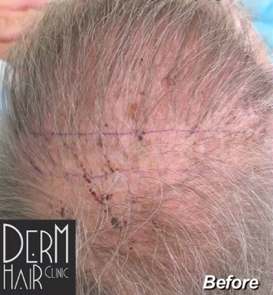 Patient With Scars and Sparse Coverage Before BHT Procedure