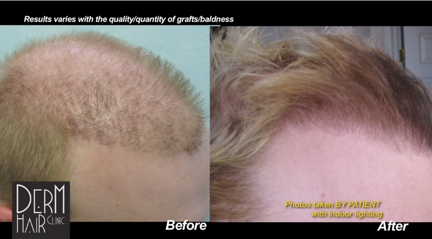 Hairline Repair With Head and Beard Hair