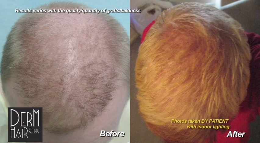 FUE Hair Restoration Using 6100 grafts, Repair Botched Hair Transplant, Top View of Body Hair Transplant Results