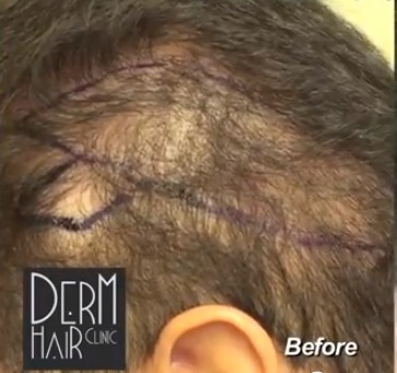 Diffuse Thinning From Shock Loss - Before Beard Hair Transplant