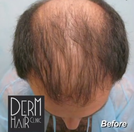 Patient Before His Facial Head to Hair Transplant Surgery