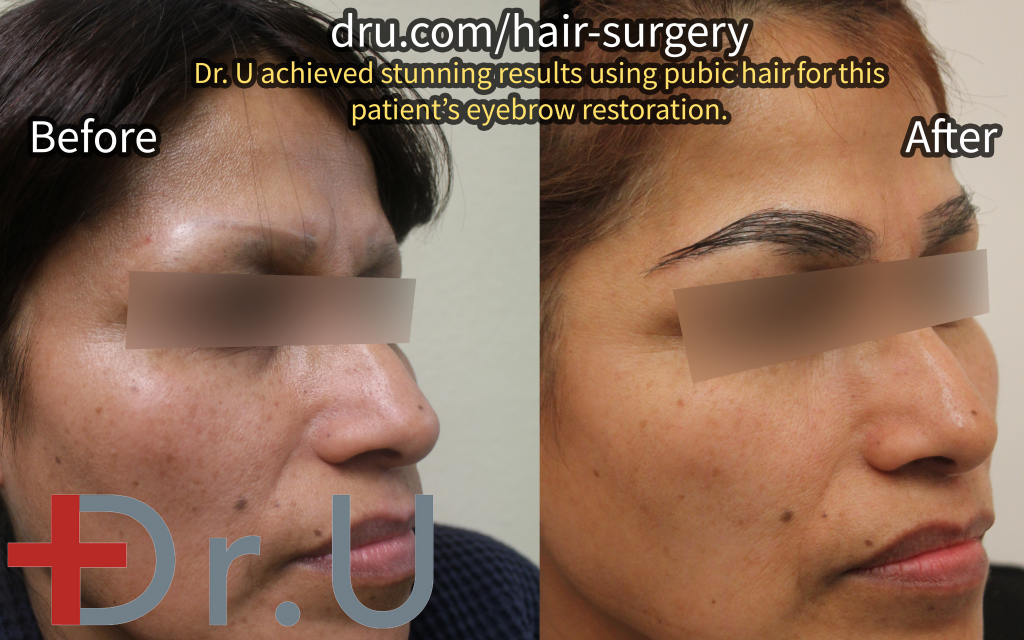 The woman's eyebrow transplant before and after photos.*