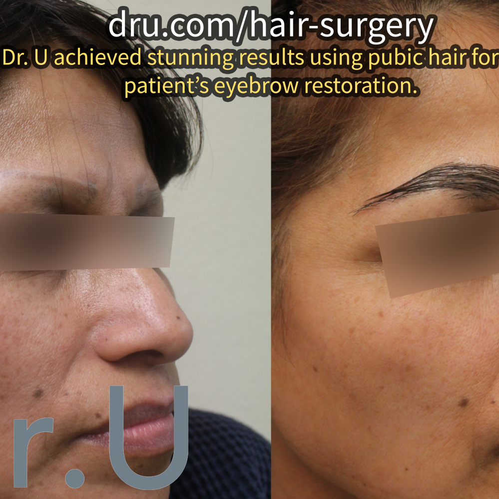 Eyebrow Implants Via Bht Pubic Hair Transplant Procedure For Laser