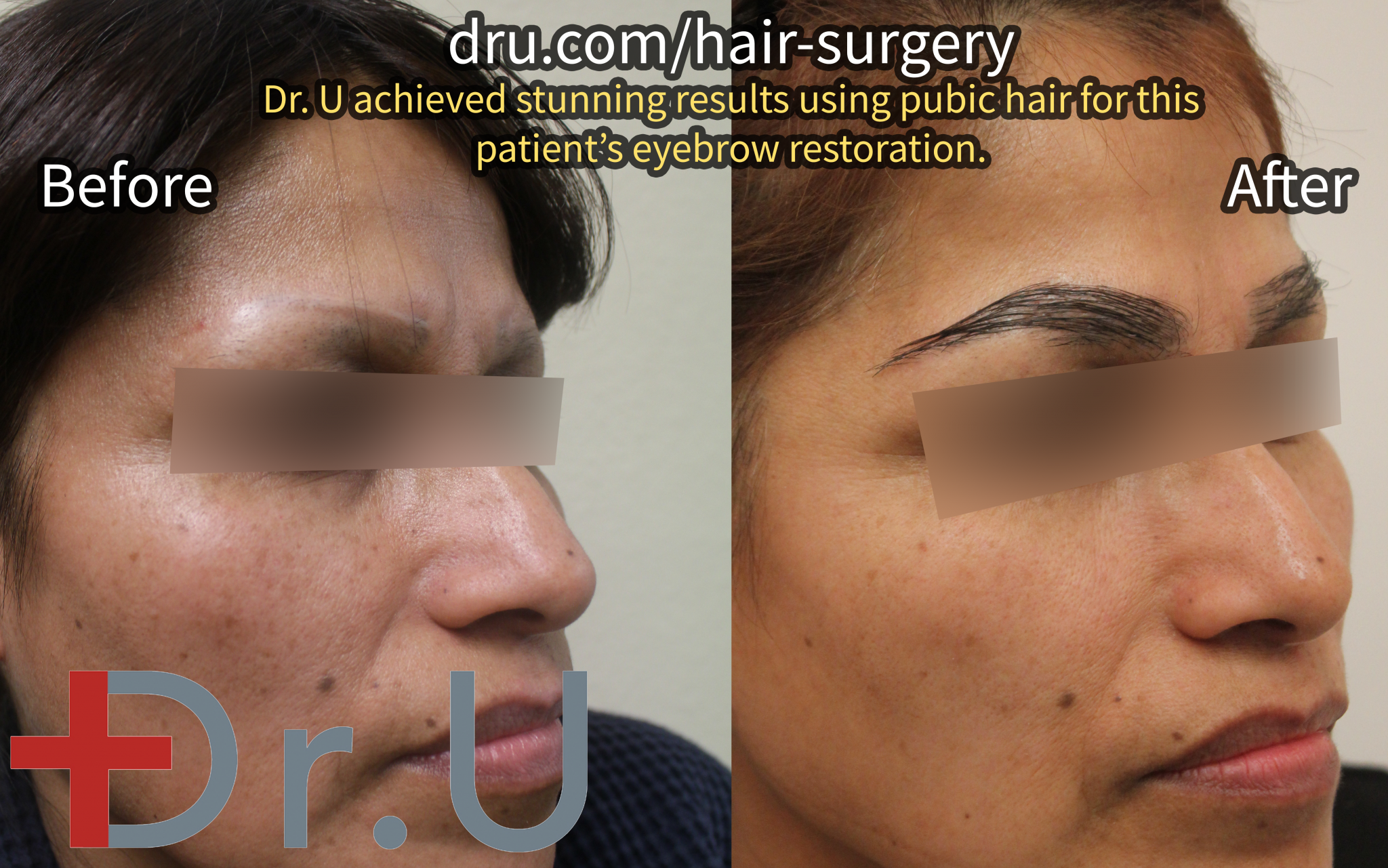 Before and After Posts - Body Hair Restoration Cases