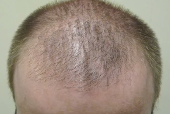 Discovering The Cause Of Your Hair Loss