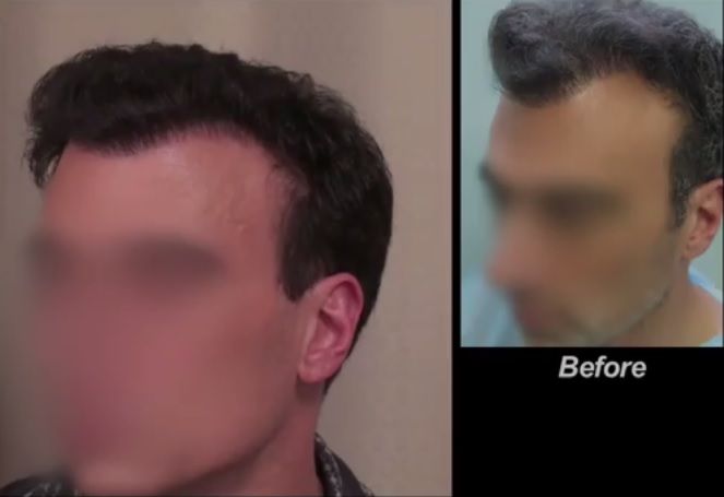 The History of the FUE Hair Transplantation Procedure led to th UGraft that created the results in this patient