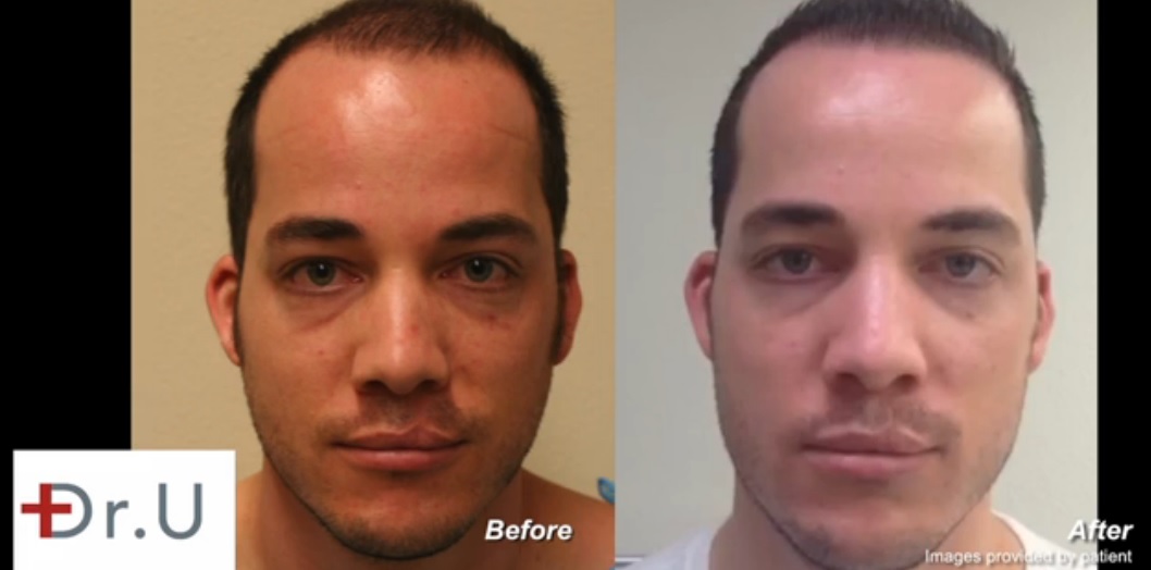 hair transplant for young patients. Young Hair Transplant Candidate