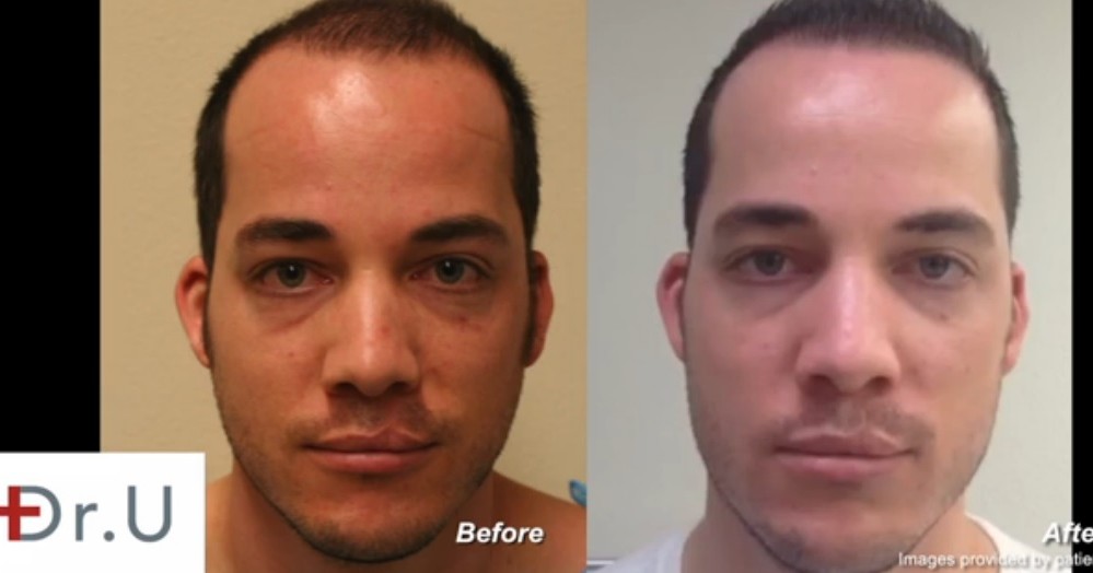 does hair transplant make you look younger
