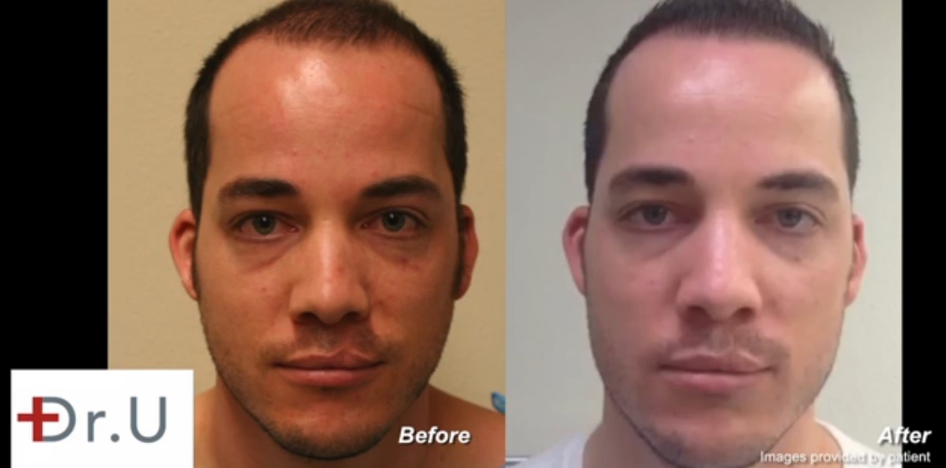 Young Patient | Advanced FUE Hair Transplant