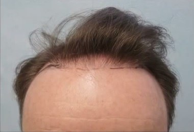 Patient Before His FUE Hairline Restoration, Before and After FUE