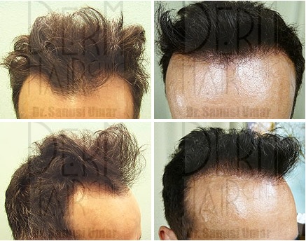 before and after conservative FUE Hair Transplant using 1450 grafts