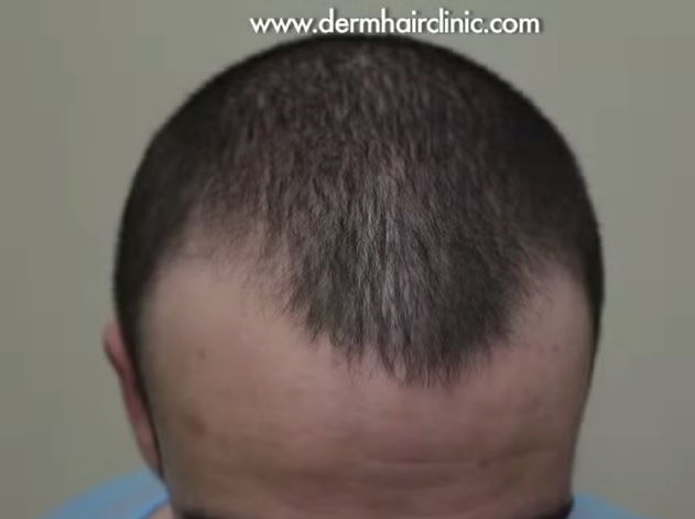 Patient's Receded Hairline Before His FUE Transplant
