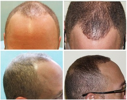 FUE Transplant For Modest Hairline Advancement