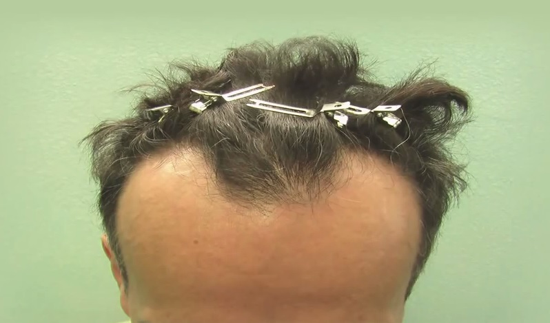 Hairline Recession on FUE Patient Prior to Hair Transplant