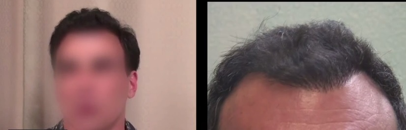 Follicular Unit Extraction: Hair transplants without linear scarring