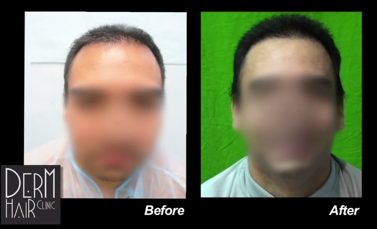 Front View of Patient's New Hairline