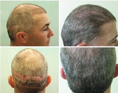 UGraft Advanced FUE Repairing strip scars from older methods of hair transplantation