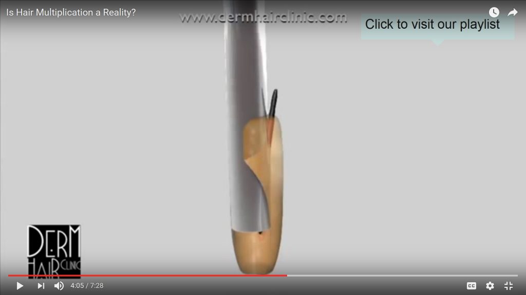 Follicular damage from tiny FUE Punch longitudinal splitting