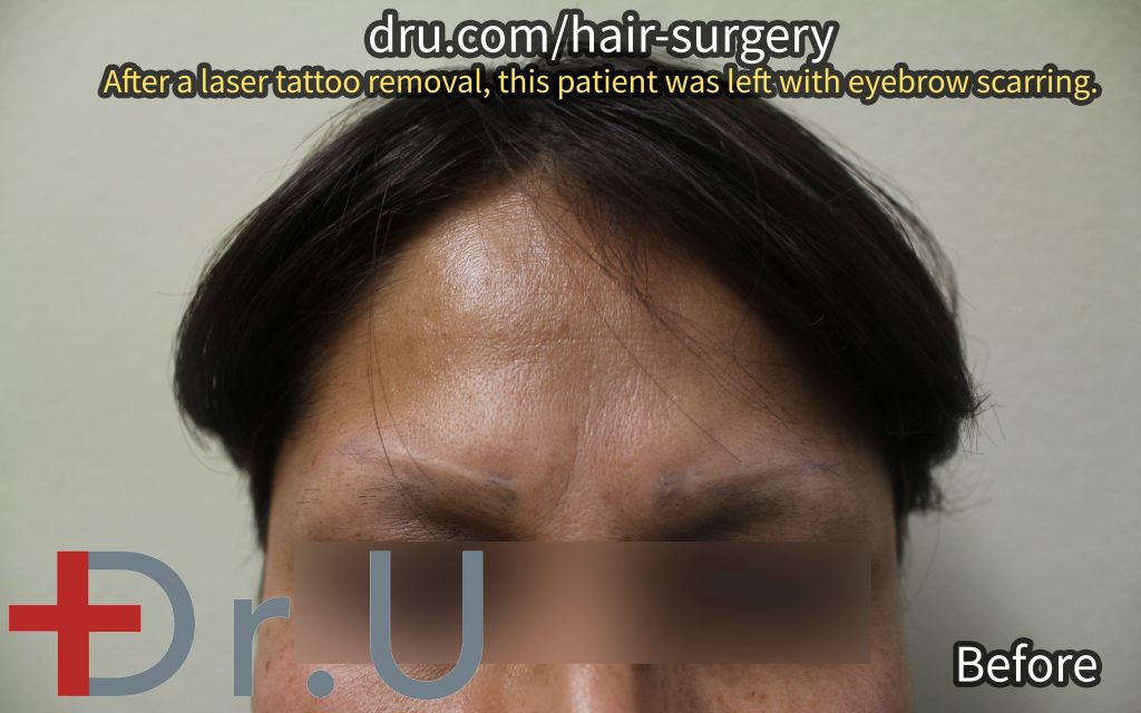 This Long Beach, Los Angeles patient came to Dr. U for eyebrow implants to cover up laser tattoo removal scars in the eyebrow area.*