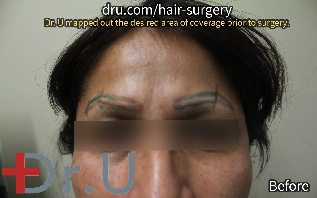 The patient in her initial planning period. Dr. U mapped where he intended to embed the eyebrow implants for her FUE body hair transplant repair procedure.*