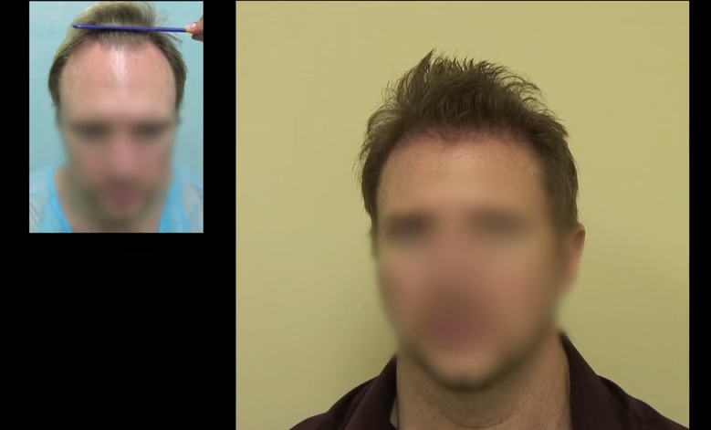 Los Angeles Hair Restoration: Follicular Unit Extraction - Solution for Shortage of Donor Hair Supply - Norwood 3 Hair Transplant Patient | New Hairline | FUE