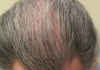 Patient Within Sparseness on Scalp Before His BHT Surgery