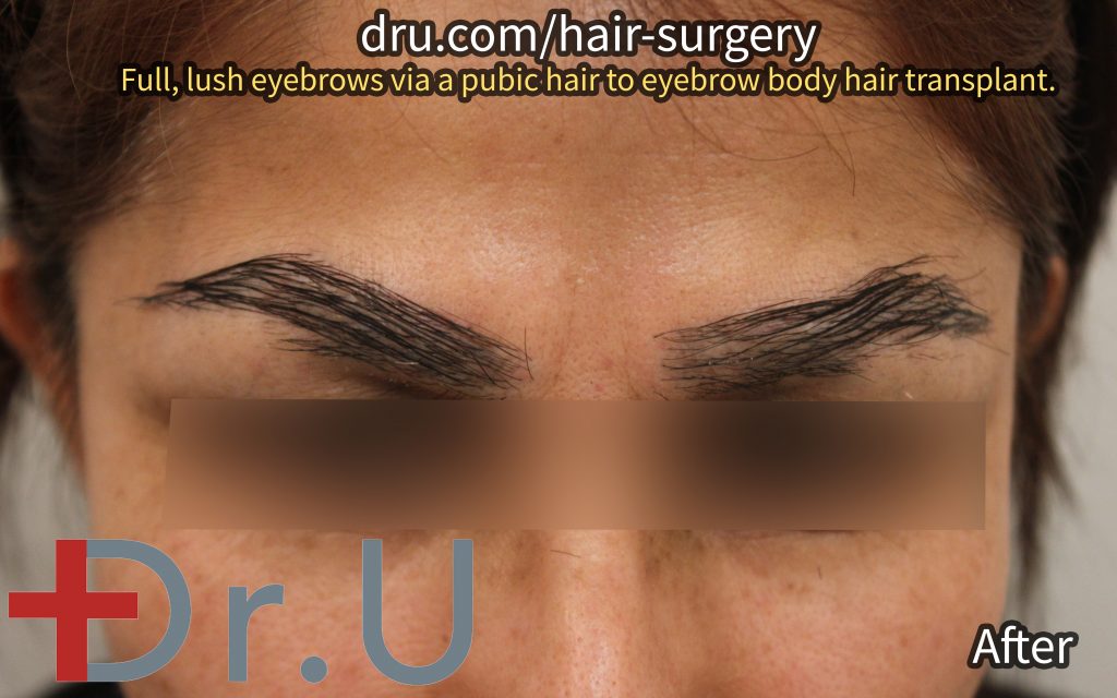 The patient's eyebrow implants after her FUE body hair transplant procedure.*