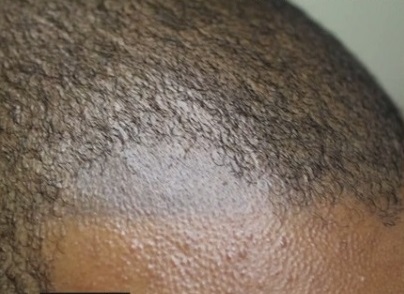 Attempt at Scalp Micropigmentation For Receding Temples