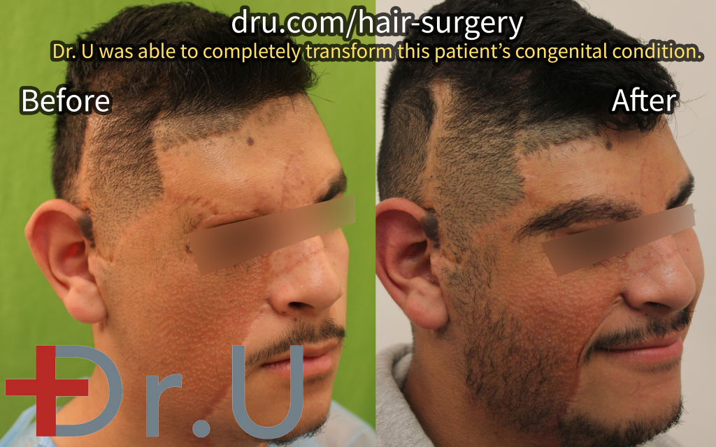 This life-changing FUE body hair transplant was used to rebuild this patient's right eyebrow and beard in the wake of the removal of a large birthmark.*