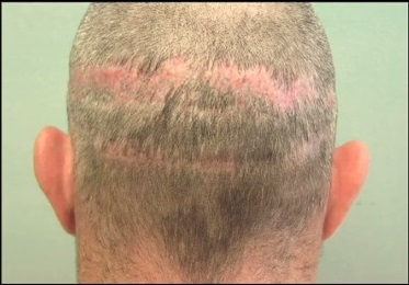 Challenging Hair Transplant Repair - Multiple Strip Scars