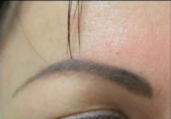 Patient Featured on KNBC Before Her Surgery, eyebrow transplant by Dr U