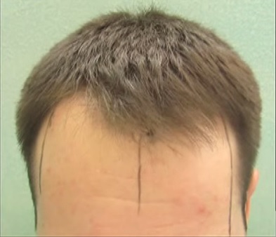 Hairline Depletion Shown On Patient Before FUE Surgery