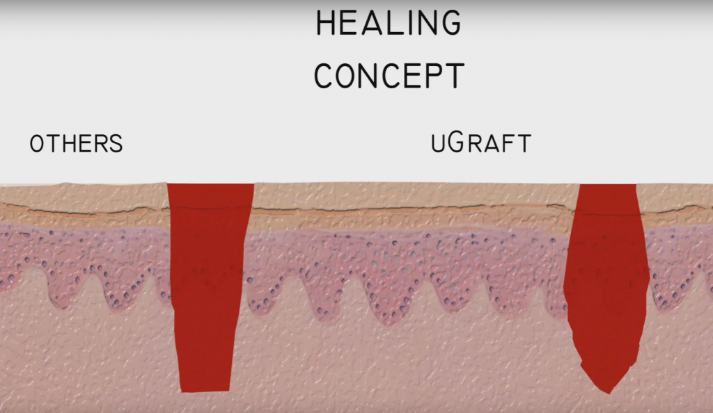 UGraft wound have more inverted than everted edges