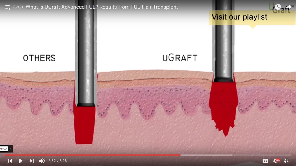 UPunch Rotor creates a wound that expands in size with depth resulting in a preferred inverted edged wound