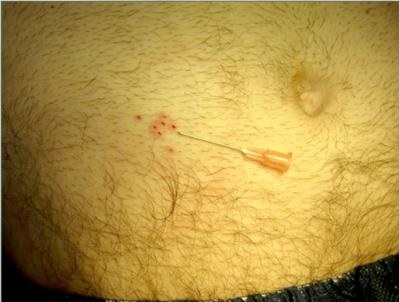 Body Hair Transplant| Test Extractions| Abdomen Body Hair Transplant| Test Extractions| Abdomen