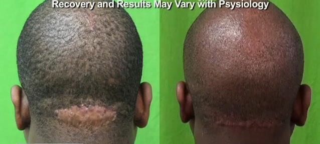  Patient before and after his Acne Keloidalis Nuchae Scar Revision Surgery - AKN Surgery Revision